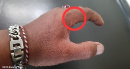 Tanda Sayatan di Jari Telunjuk kiri Pada Malam 1 Syuro Penuh Makna!